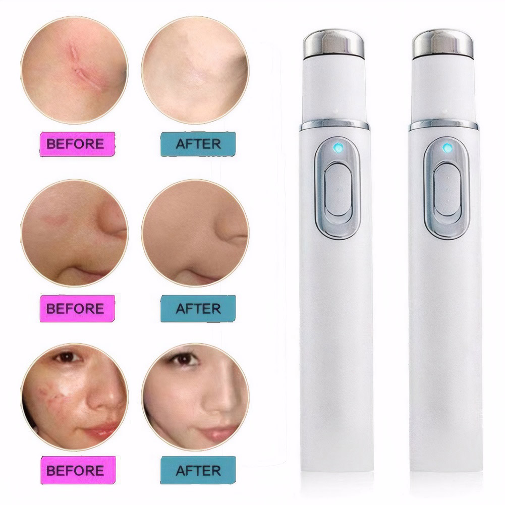 Blauwlichttherapie Acne Pen LE - Acne Light Therapy Pen recensie en prijs