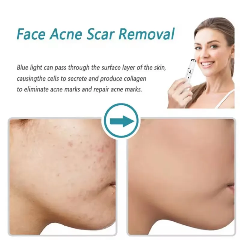Blauwlichttherapie Acne Pen Oo - Acne Light Therapy Pen recensie en prijs